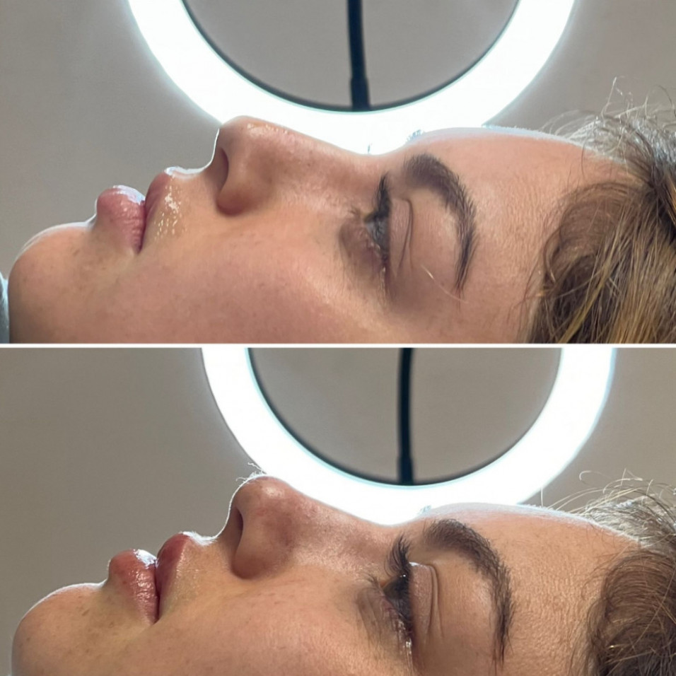 hyaluronic acid for my lips and nose